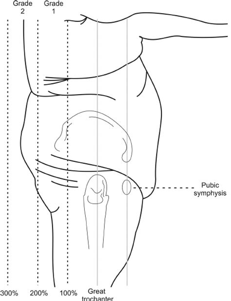 Because of its ability to reduce bulges in the upper pubic area, mentoplasty can also reduce the appearance of a saggy pubic region. . Panniculus hangs below level of pubis